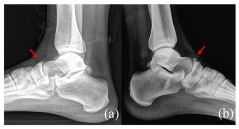 Medicina | Free Full-Text | Treatment of Navicular Stress Fracture Accompanied by Os ...