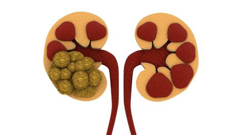 Uremia: What Is Uremia?