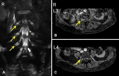 MRI findings in lumbar nerve roots. A: On day 13 of illness, lumbar... | Download Scientific Diagram