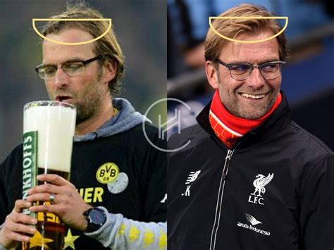 Jurgen Klopp Hair Transplant - Hair Loss & Technical Analysis