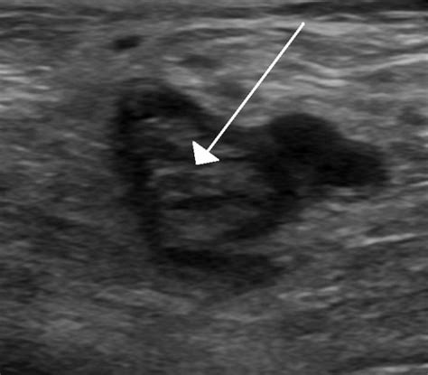 Symptoms of Blood Clot in Leg • MyHeart