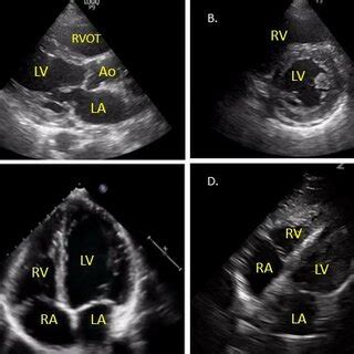 Parasternal short axis (PSAX) view at the level of A) aortic valve ...