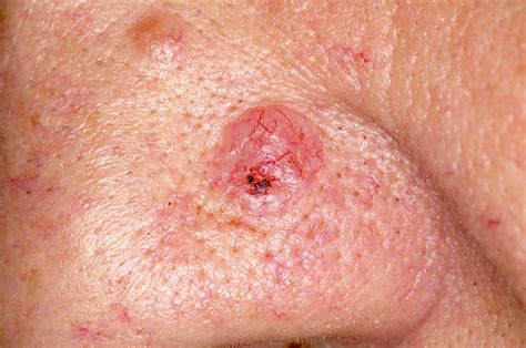 Basal Cell Carcinoma Photograph by Science Photo Library