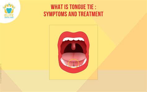 Tongue Tie: Symptoms and Treatment | Elite Dental Care