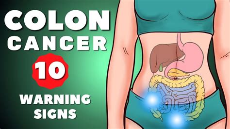 Colon Cancer Symptoms | Colorectal Cancer | 10 warning signs of Colon ...