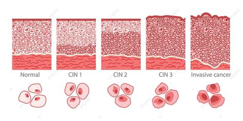 Infographic Illustrating Stages Of Cervical Cancer Cells Including Elongated Dysplasia Within ...