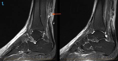 Achilles Tendon MRI - Sports Imaging - Melbourne Radiology