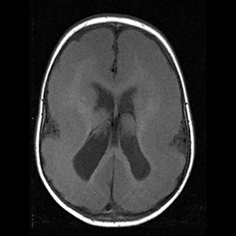 Lissencephaly Mri