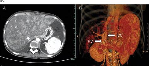 Figure 1 from Graft Failure From Hepatic Veno-Occlusive Disease After a ...