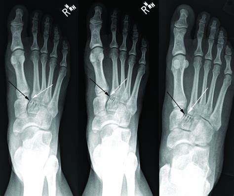 Lisfranc injuries | The BMJ