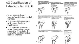 Implants for extracapsular neck of femur fracture dynamic | PPT