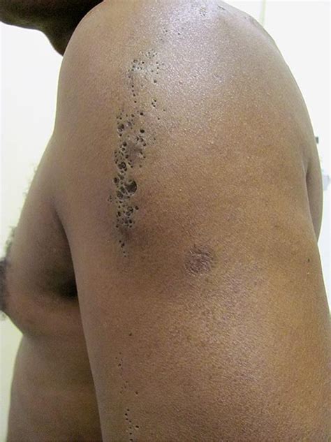 Nevus Comedonicus: Case Report | Semantic Scholar