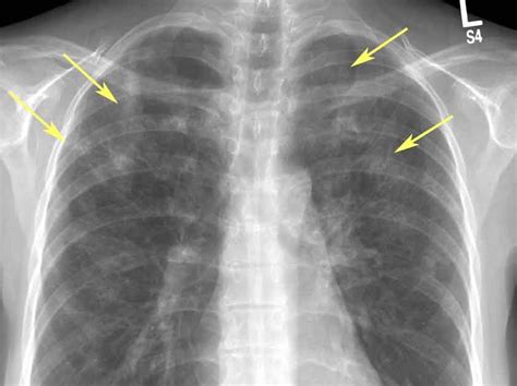 RiT radiology: Drug-Induced Eosinophilic Pneumonia