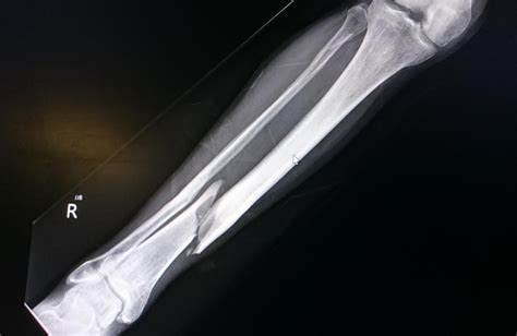 Bone fracture in x-ray. What to know about bone fracture repair | Bone fracture, Fracture ...