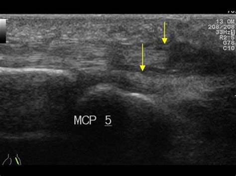 Musculoskeletal Joints and Tendons | 6.4 Fingers : Case 6.4.6 Traumatic tendon lesions ...