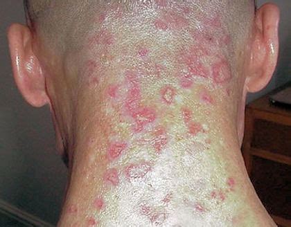 medica world: Morgellons causes treatment symptoms and signs