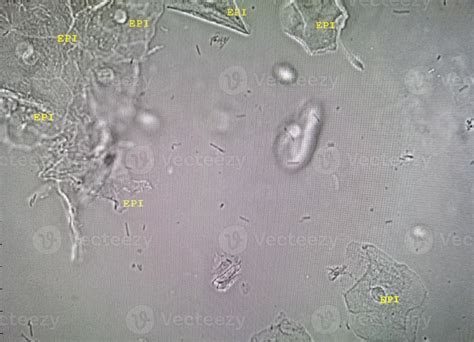 Microscopic image of abnormal urinalysis. urine exam. Urine routine examination. 12601211 Stock ...