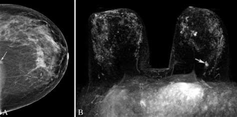 (A,B): Mammogram, craniocaudal projection (A) and maximum-intensity... | Download Scientific Diagram