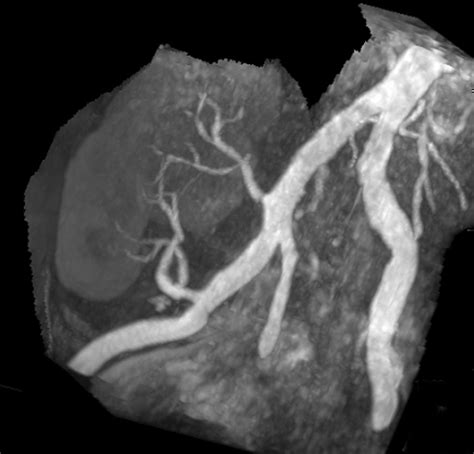 Phase Contrast MRA - Questions and Answers in MRI