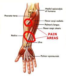 Forearm pain. Forearm splints (feels like shin splints in your forearm ...