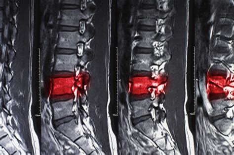 Recommendations for Secondary Fracture Prevention in Elderly Patients - Endocrinology Advisor