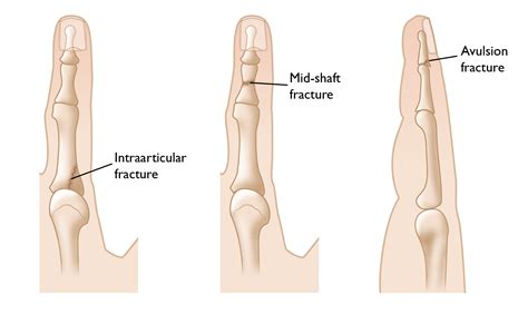 Finger Fractures - OrthoInfo - AAOS