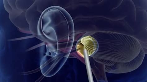 Endoscopic Microvascular Decompression - BroadcastMed