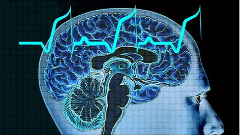 Management of Idiopathic Generalized Epilepsies - UW Medicine Provider Resource