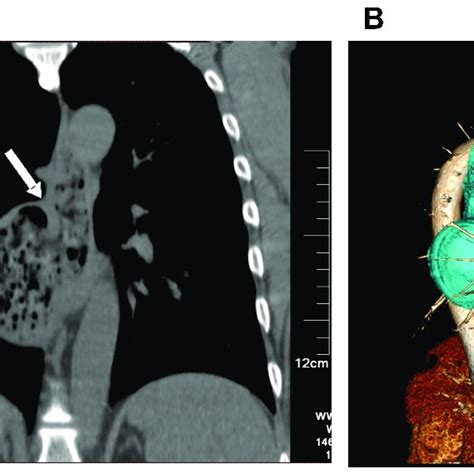 (A) Mediastinal window of CT scan frontal plane shows that outpouching... | Download Scientific ...