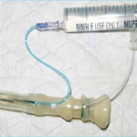 SI stent positioned. Oral push enteroscopy. | Download Scientific Diagram