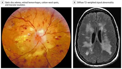 Abnormal Magnetic Resonance Imaging Findings in a Patient With Optic Disc Edema, Retinal ...