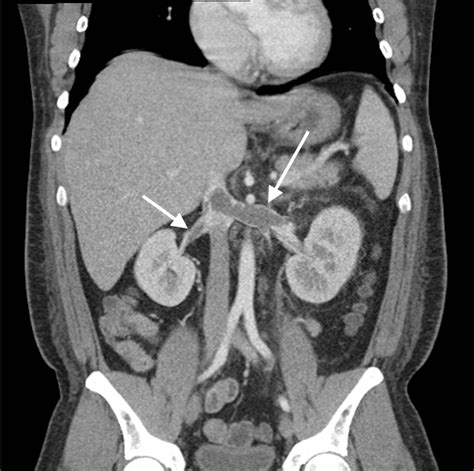 Cureus | Bilateral Renal Vein Thrombosis in Membranous Nephropathy ...