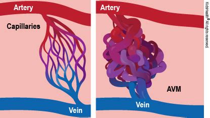 Arteriovenous Malformations (for Parents) - Seattle Children's Hospital