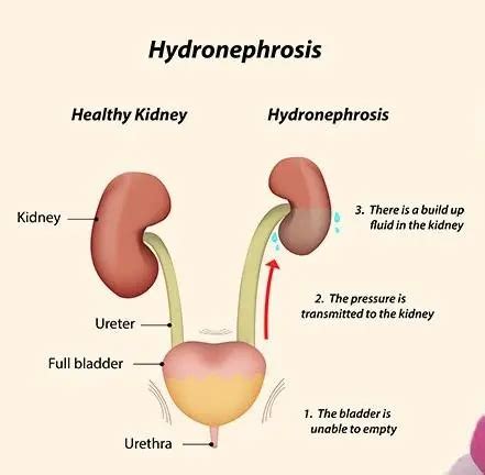 Hydronéphrose : Symptômes, causes et diagnostic