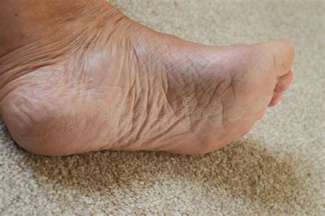 Sore Cracked Dry Skin on Feet Dry Dehydrated Feet of a Lady Stock Image ...