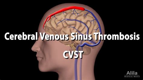 Cerebral Venous Sinus Thrombosis, CVST, Animation - YouTube