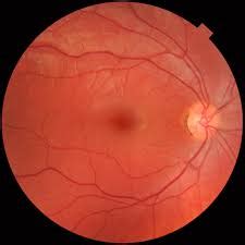 What is Fundus Photography? - Retina Specialist - Buffalo New York ...