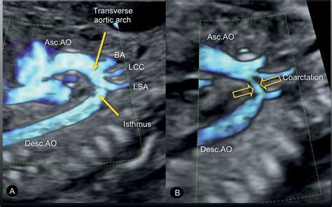 Coarctation of the Aorta and Interrupted Aortic Arch | Obgyn Key