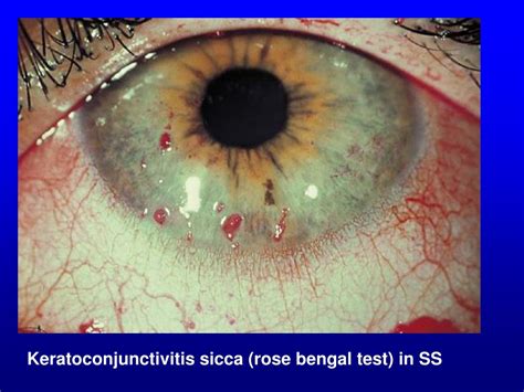 Keratoconjunctivitis Sicca Icd 10 : Optometric Management | Landrisand