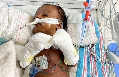 Baby Born with Congenital Heart Disease Receives Treatment at Holtz ...