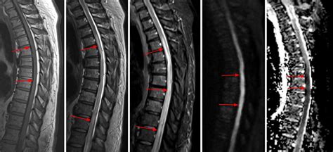 Spinal Cord Infarct | The Neurosurgical Atlas