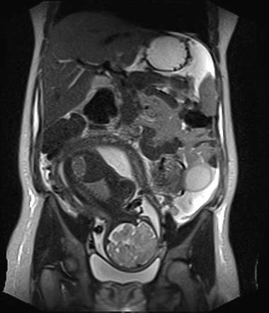 Sigmoid volvulus in pregnancy (MRI) | Image | Radiopaedia.org