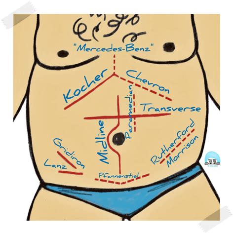 Abdominal incisions: the names and anatomical locations - The Scrub Nurse