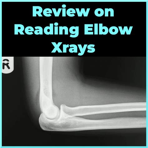 Elbow Radiographs: Expert Analysis - Sports Medicine Review