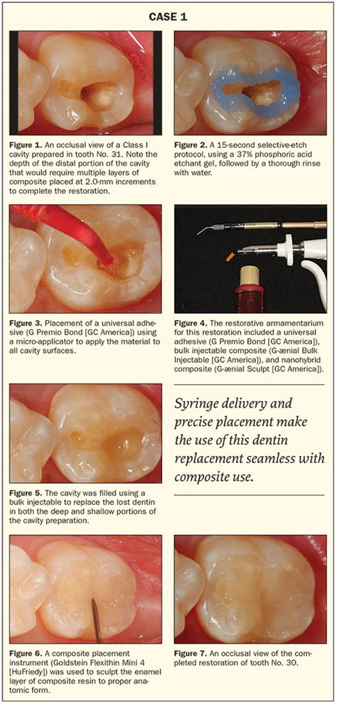 Material Options for Class II Composite Restorations: Varied Clinical Parameters Require ...