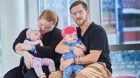 Conjoined Twins News and Updates | Children's Hospital of Philadelphia