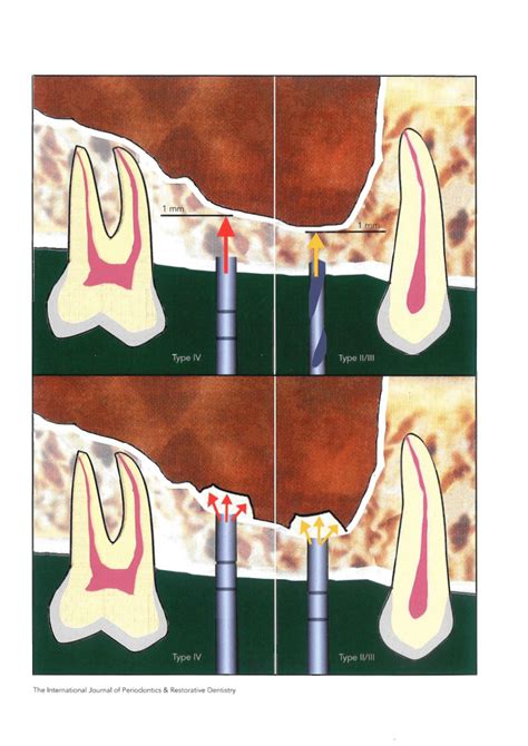 (PDF) Simplified osteotome sinus augmentation technique with ...