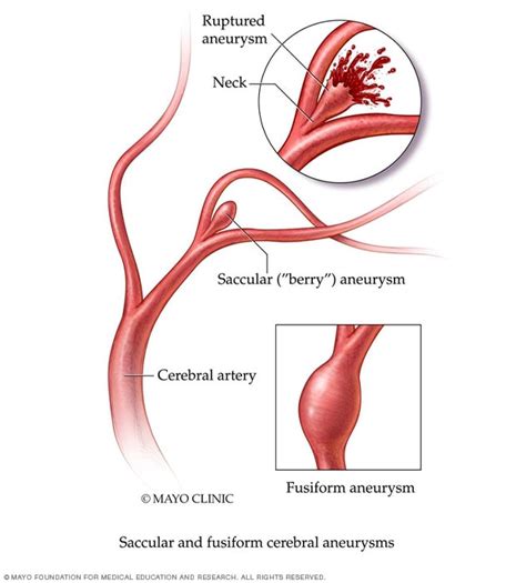 Brain aneurysm - Symptoms and causes (2023)