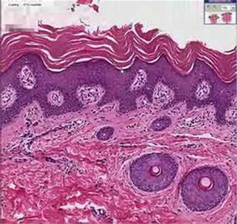 Ichthyosis Vulgaris Histology