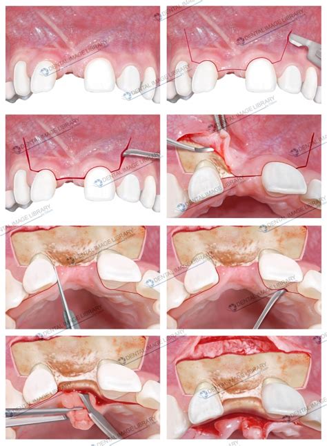 Collection step-by-step illustrations. Buccal and palatal flap design ...